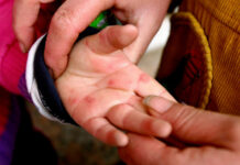 Explainer: Why children are at risk of hand, foot and mouth disease There is no vaccine for hand