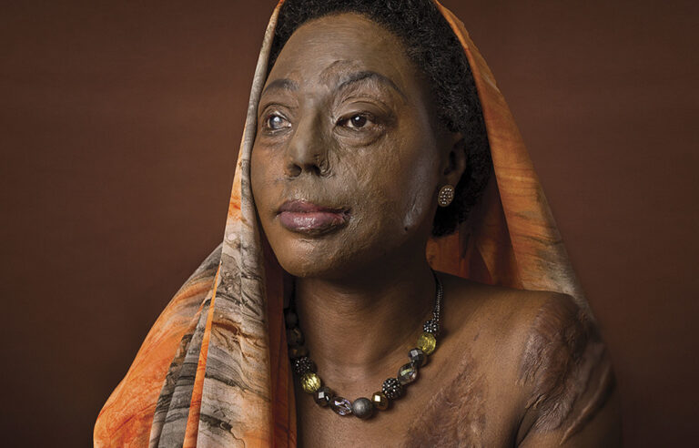 Acid attacks: ‘I didn’t have the money to buy justice, but I had brains to go on’