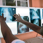 The LAM urine test allows doctors to diagnose a seriously ill HIV patient with tuberculosis in just 25 minutes. No special laboratories or technicians are required to administer the test