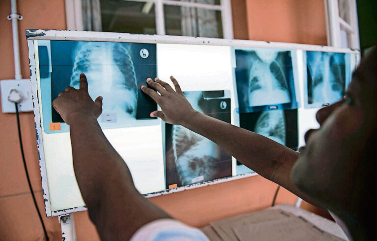 Quick urine TB test a life-saver, but only in certain cases