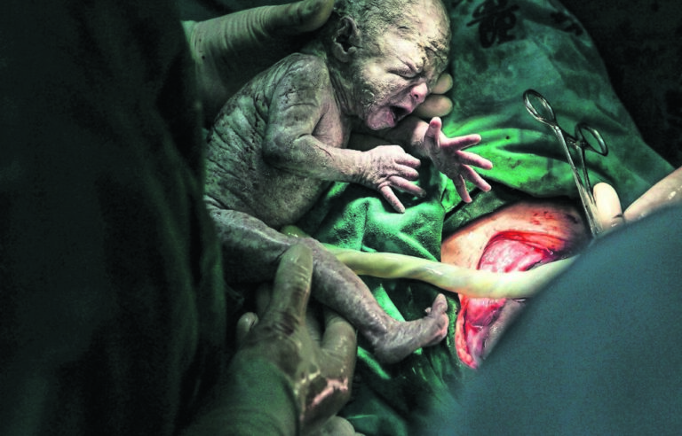 Caesarean vs vaginal birth: A mother’s choice, not her doctor’s