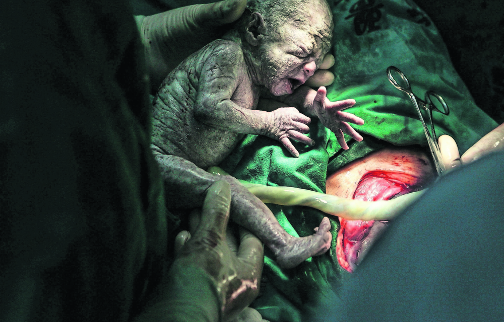 It's not only women who prefer Caesarean sections