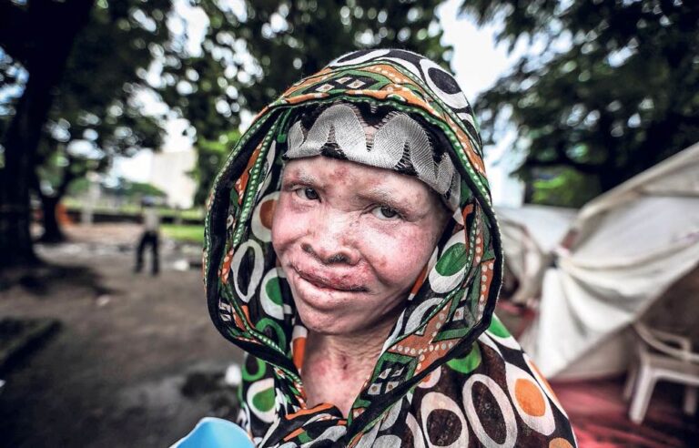 Bones of Gold: Report reveals how people with albinism are abducted and killed for their body parts