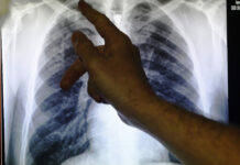 Comment: Do we take state help for granted? There is evidence to suggest that TB itself is a risk factor for developing diabetes.