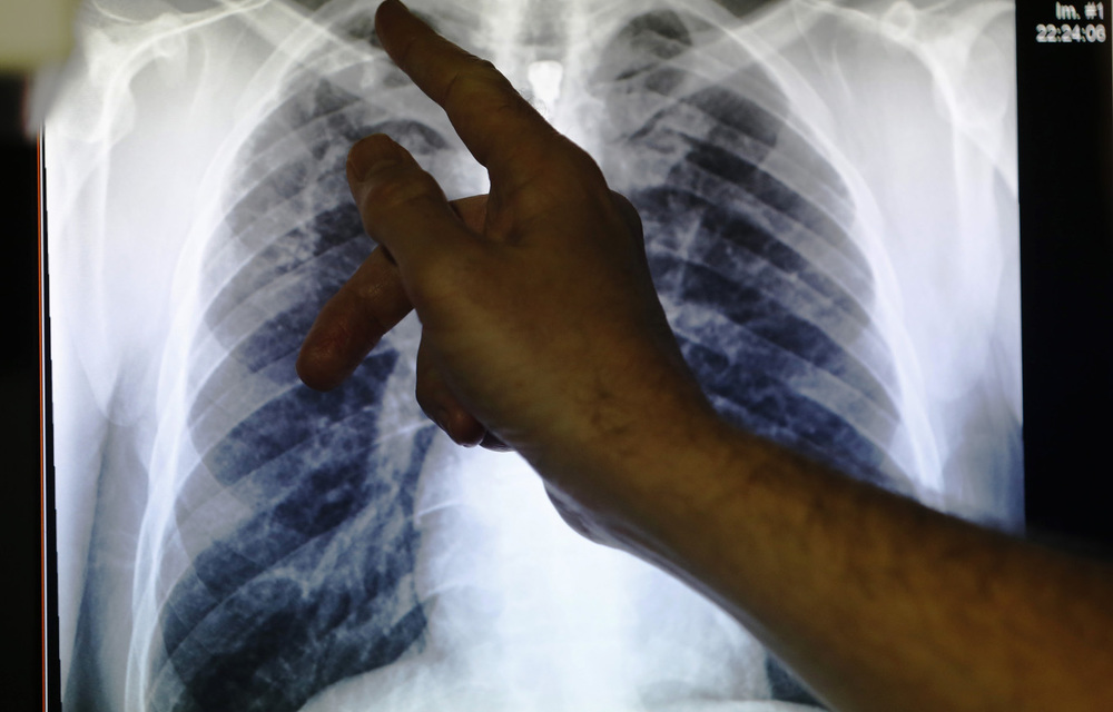 There is evidence to suggest that TB itself is a risk factor for developing diabetes.
