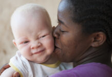 Victims of superstition: The dangers of living with albinism in Africa Victims of superstition: The dangers of living with albinism in Africa