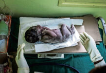 Technology speeds up diagnosis and HIV testing for babies in Mozambique Clinics in Mozambique are testing the effect of rapid early diagnosis of HIV and treatment on babies.