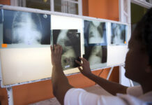 The SHINE trial – hope for shorter, kinder TB treatment for children
