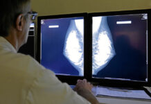 Double mastectomy – a drastic measure Mammography is still the gold standard of breast screening.