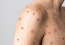 No mpox jabs for SA yet — but WHO and Africa CDC will help us fund the fight against the outbreak