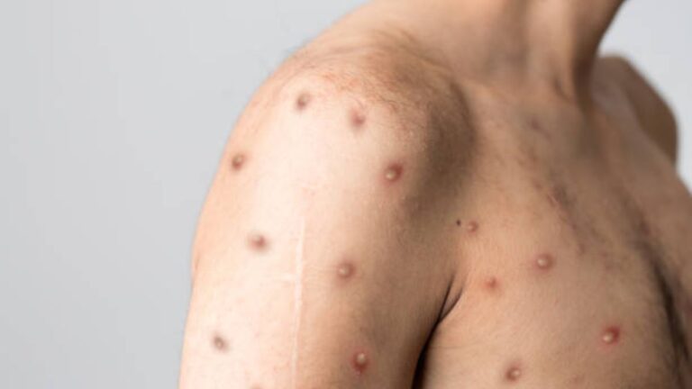 No mpox jabs for SA yet — but WHO and Africa CDC will help us fund the fight against the outbreak