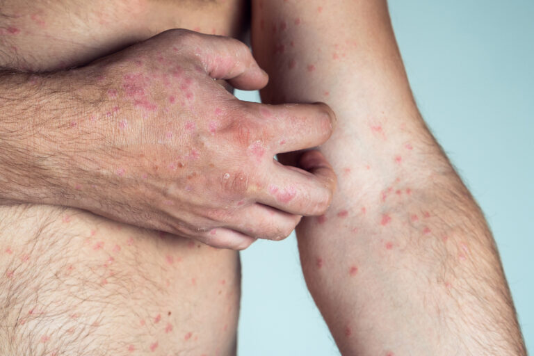 7 mpox cases, 2 deaths: Jabs and treatment could arrive in days