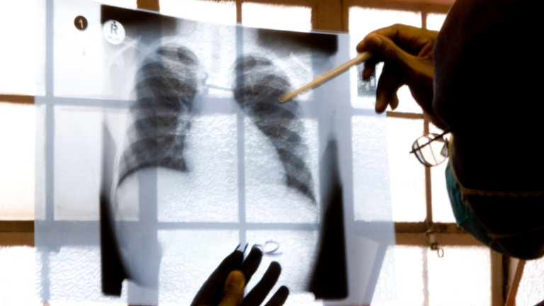 A R60 test could help SA test millions more people for TB. But will it miss the most dangerous cases?